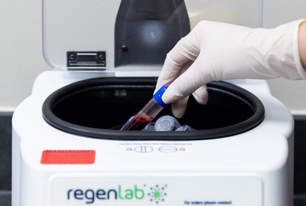A provider's hand, wearing a white surgical glove, loads a blood sample into a centrifuge. When it's done, the provider will withdraw the separated platelet-rich plasma as an alternative injection to lip filler in Mansfield.